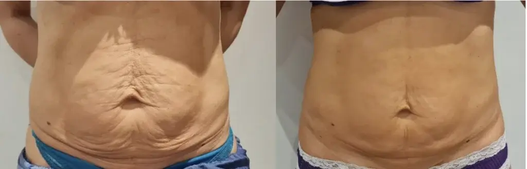 Before and after with XeiuC Collagen Oil